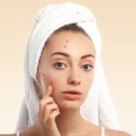 Clear Skin Ahead: Understanding and Treating Acne