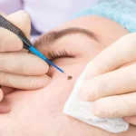 Say Goodbye to Moles & Warts: Safe and Effective Removal Options